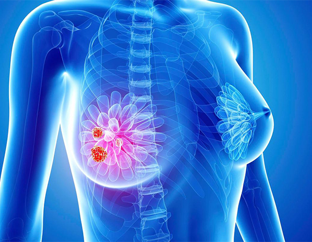 Sintomas de cancer de mama: 12 sinais.