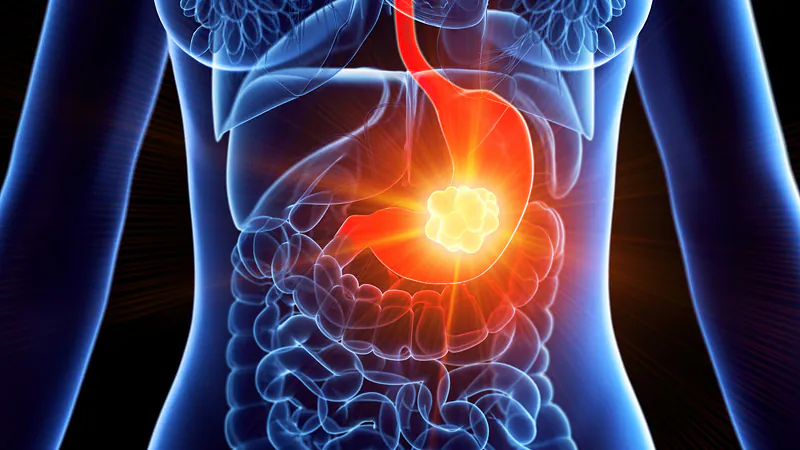 Cancer No Estomago Sintomas Causas E Tratamento cancer-no-estomago-sintomas-causas-e-tratamento